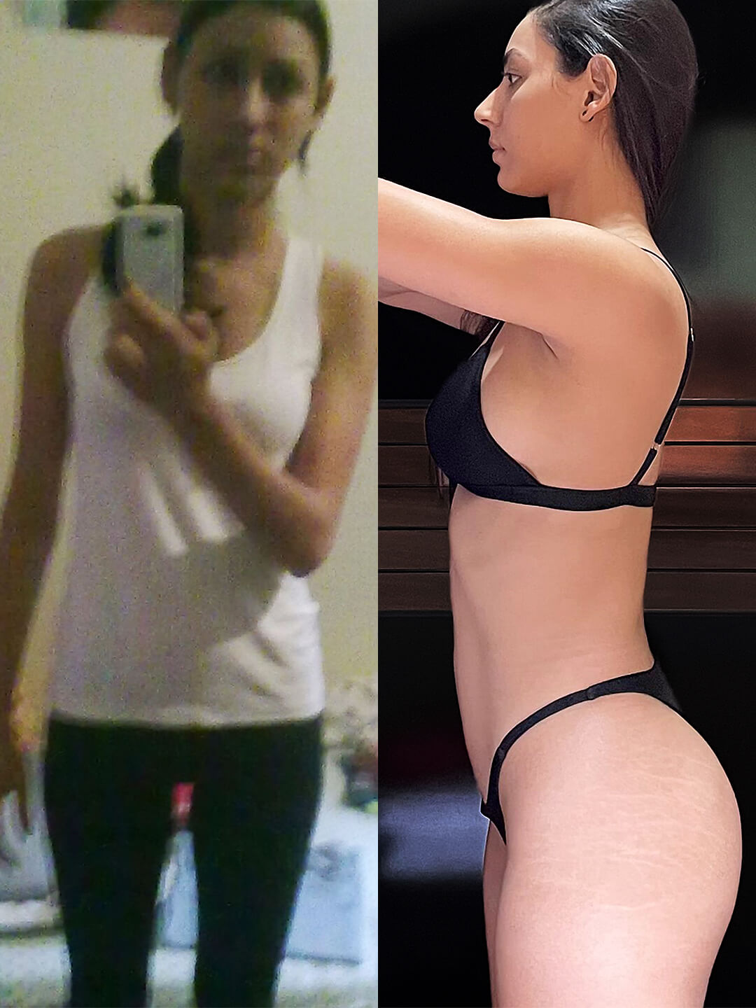 Antes e Depois Suelen